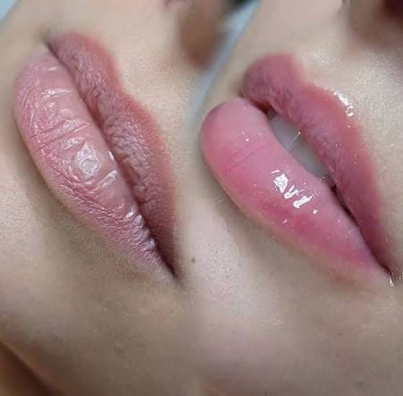 Tratamiento de labios